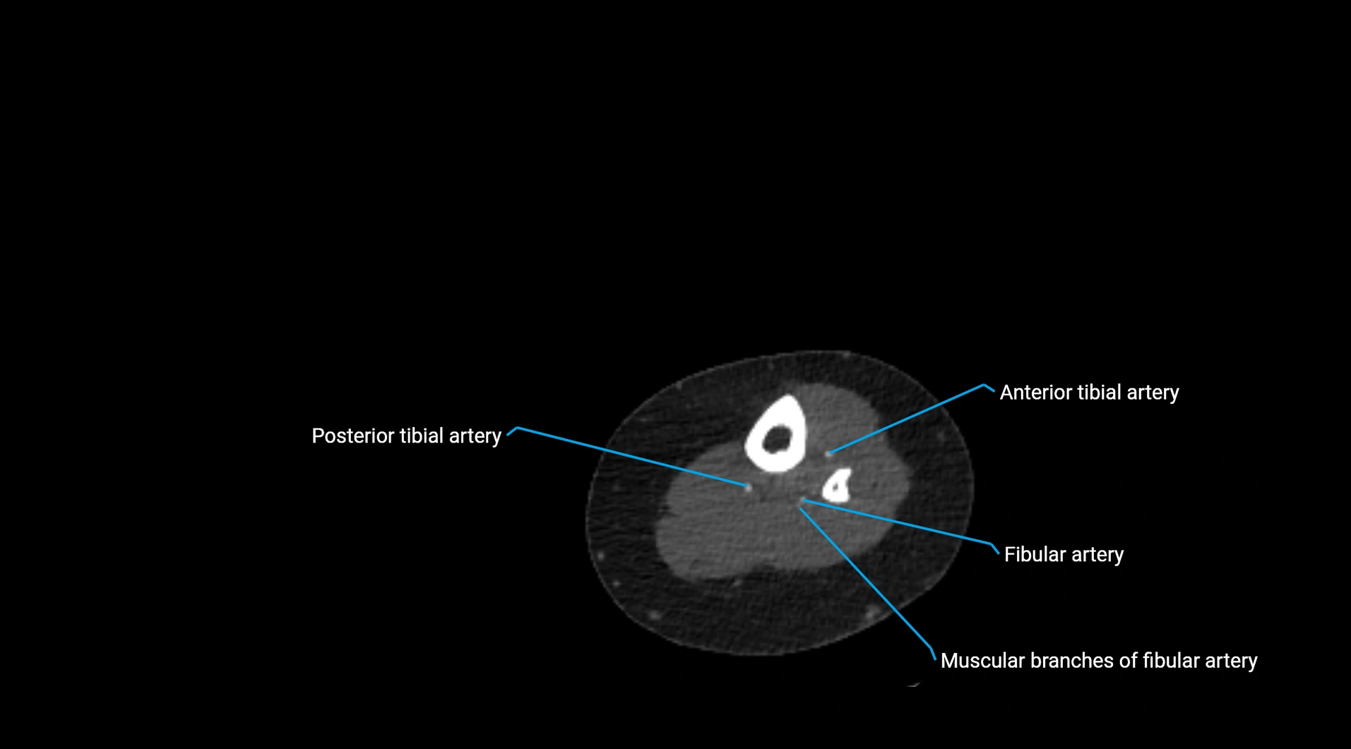 CTA lower limb cross sectional anatomy labelled image _222.webp